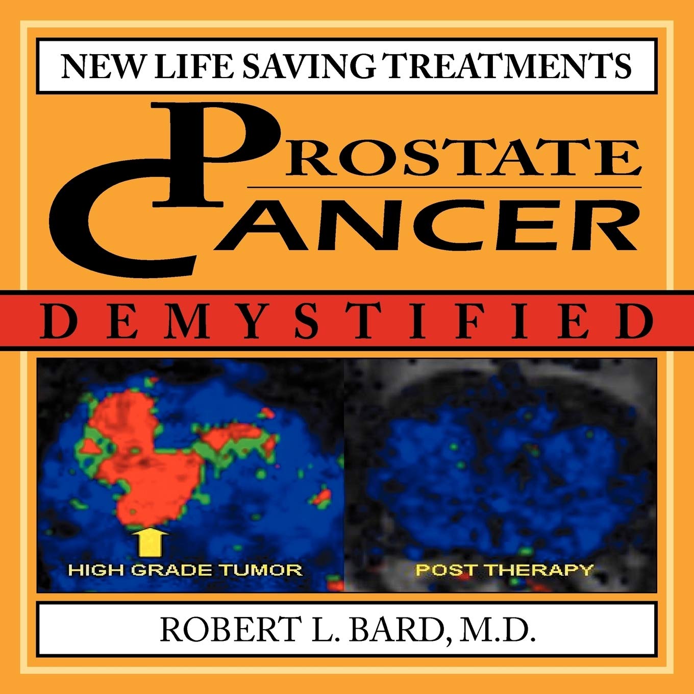 Prostate Cancer Demystified: New Life-Saving Treatments Explained