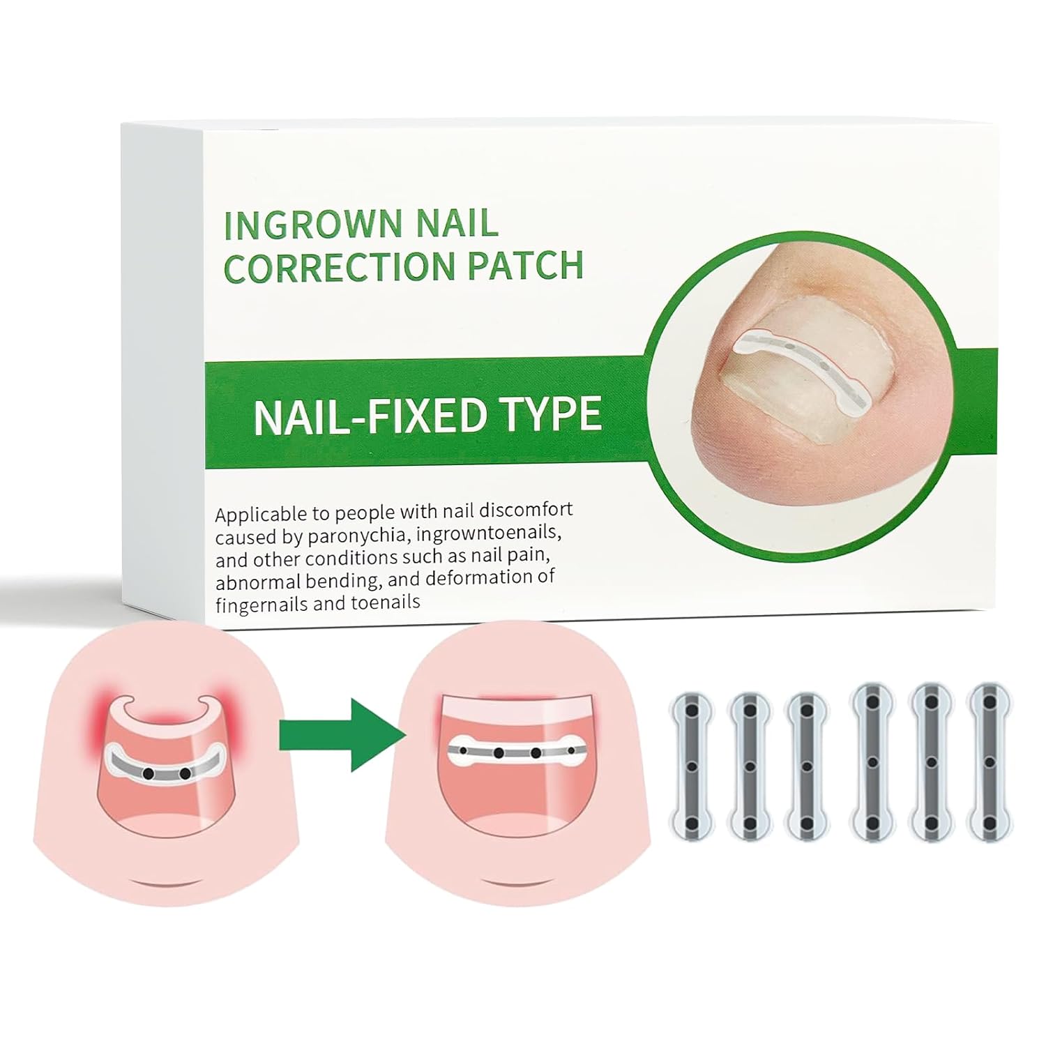 Titanium Alloy Ingrown Toenail Treatment Kit for Home Use