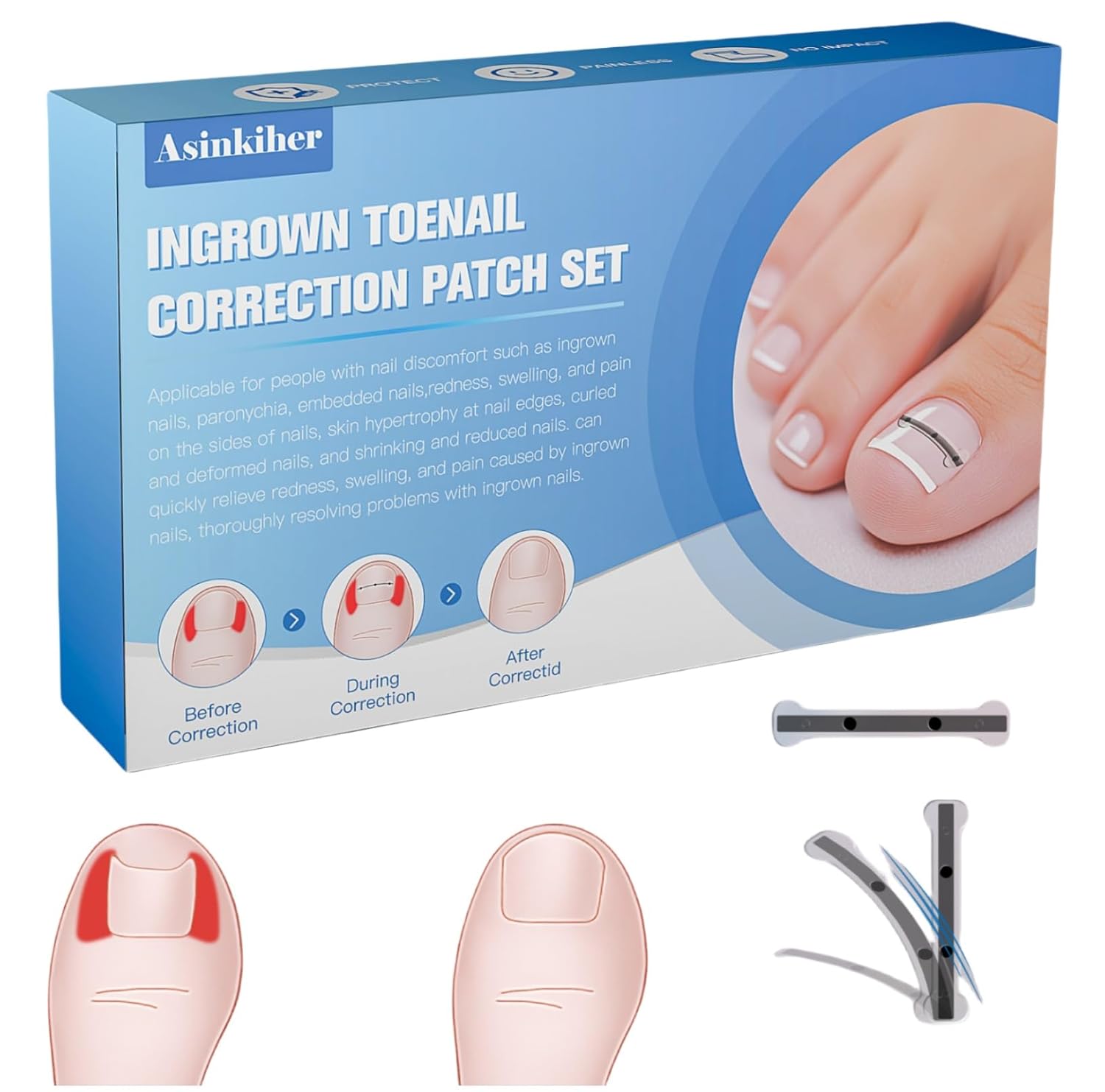 Titanium Alloy Ingrown Toenail Treatment for Home Use