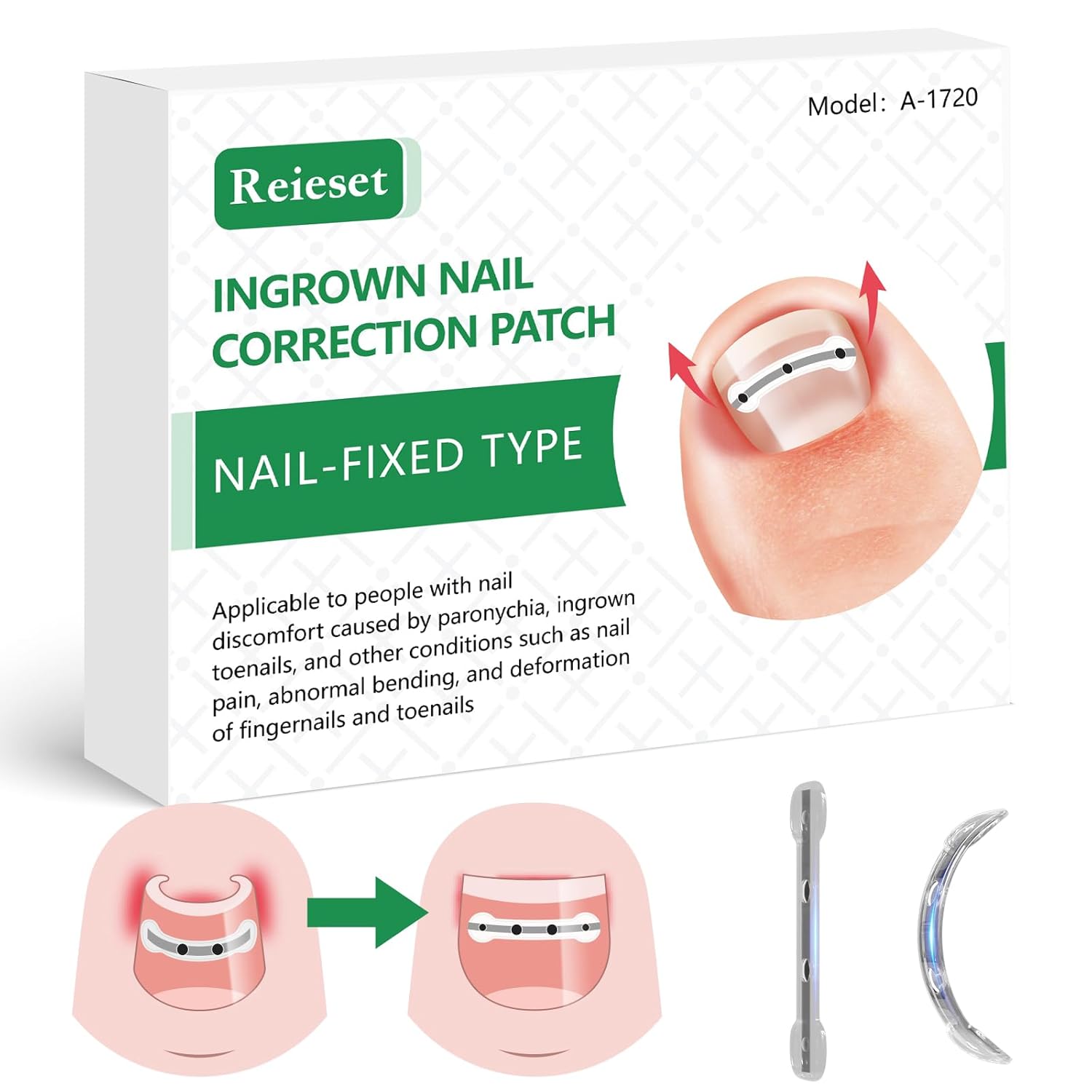 Titanium Alloy Ingrown Toenail Treatment for Curved Nail Repair