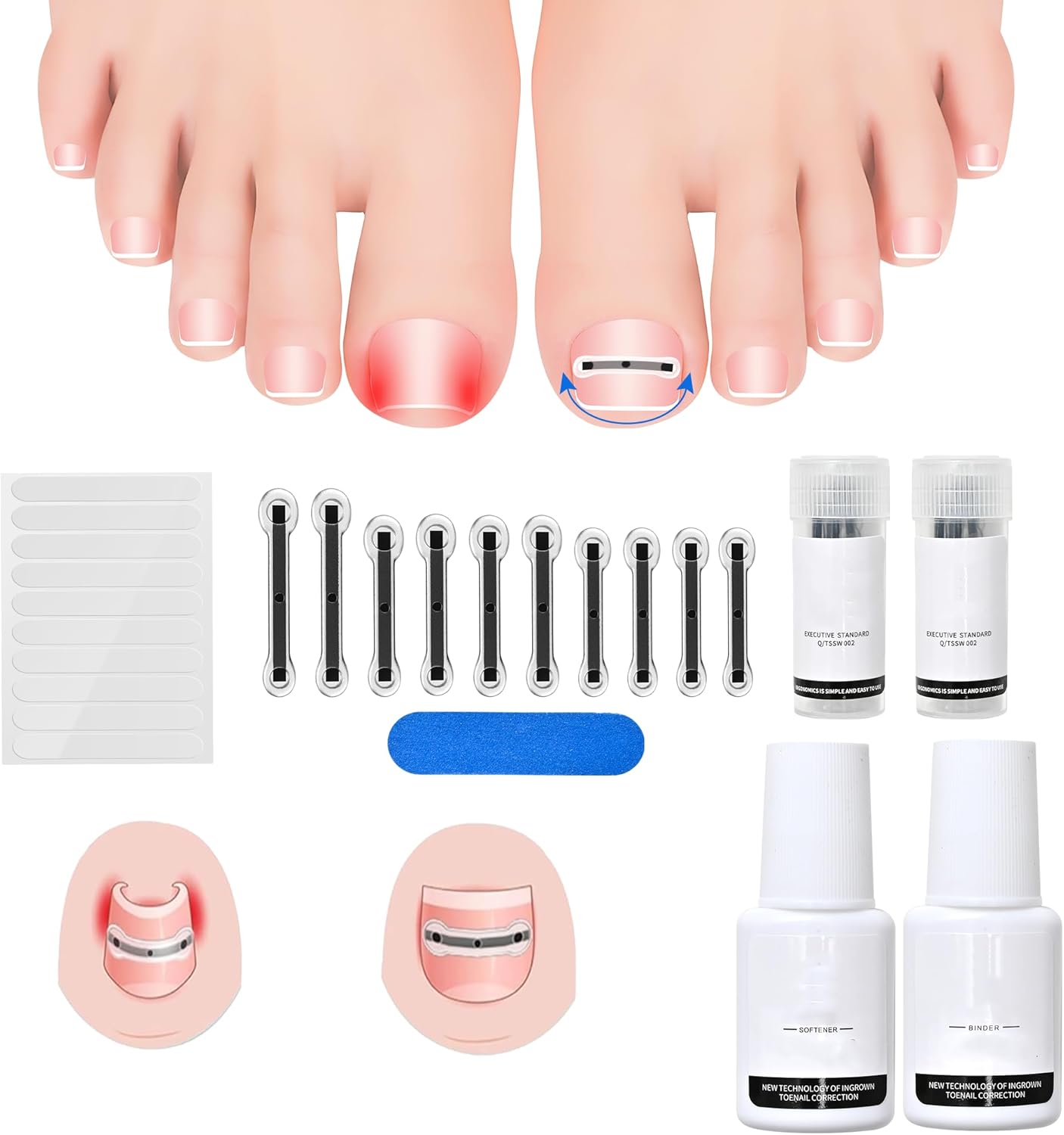 Titanium Alloy Ingrown Toenail Corrector Kit for Quick Relief